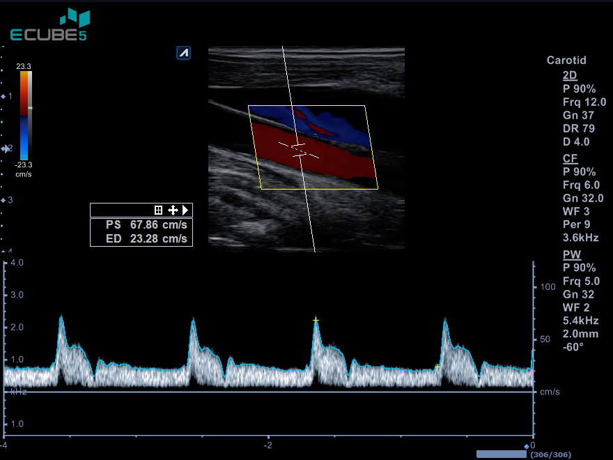 carotid_cf_pw3.jpg carotid_cf_pw3.jpg